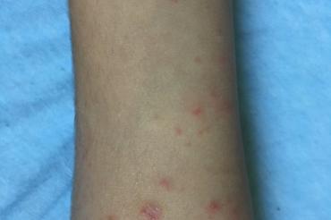 Dermatitis