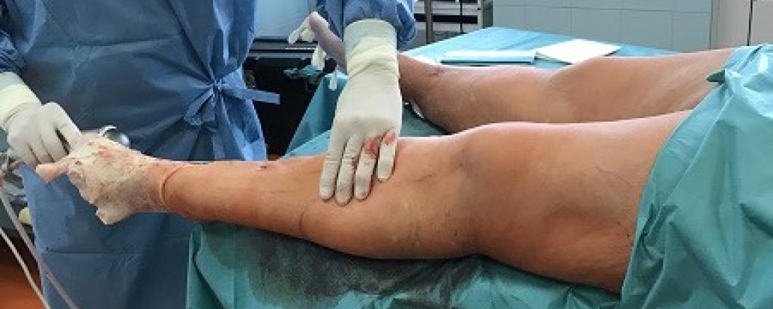 Diagnose Lipödem: Wenn Fettzellen außer Kontrolle geraten 1