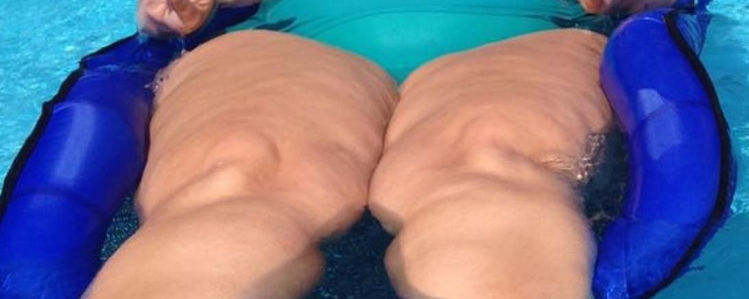 Diagnose Lipödem: Wenn Fettzellen außer Kontrolle geraten