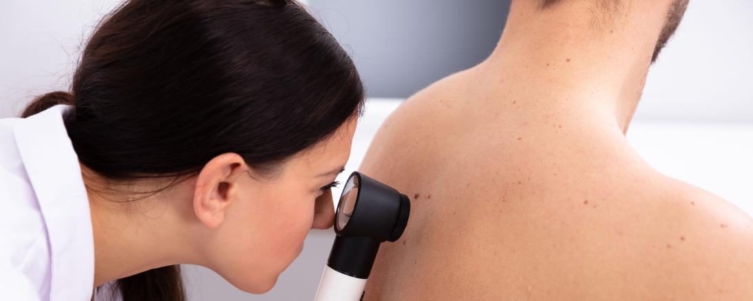 Nur mit regelmäßigen Chek-Ups kann Hautkrebs früh erkannt und damit besser behandelt werden.